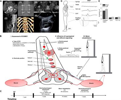 Supraspinal and Afferent Signaling Facilitate Spinal Sensorimotor Network Excitability After Discomplete Spinal Cord Injury: A Case Report